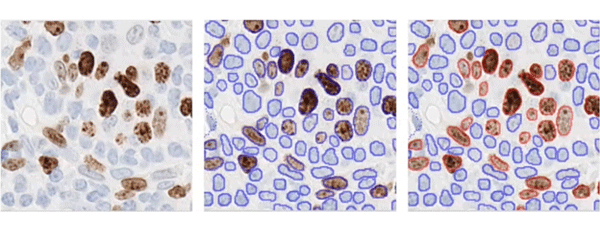 Zooming in on the tumor region as shown below, the algorithm first identifies the tumor nuclei that are present (see the image on the left). The middle image displays outlines of the nuclei identified by the algorithm, while the right image shows the nuclei outlined in red, which are classified as Ki67-postive. This information can help the pathologist better understand the tumor area, the percentage of Ki67-positive cells and its distribution.